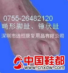 锤状趾垫 爪状趾垫 弯曲脚趾纠正垫 畸形脚趾矫正垫